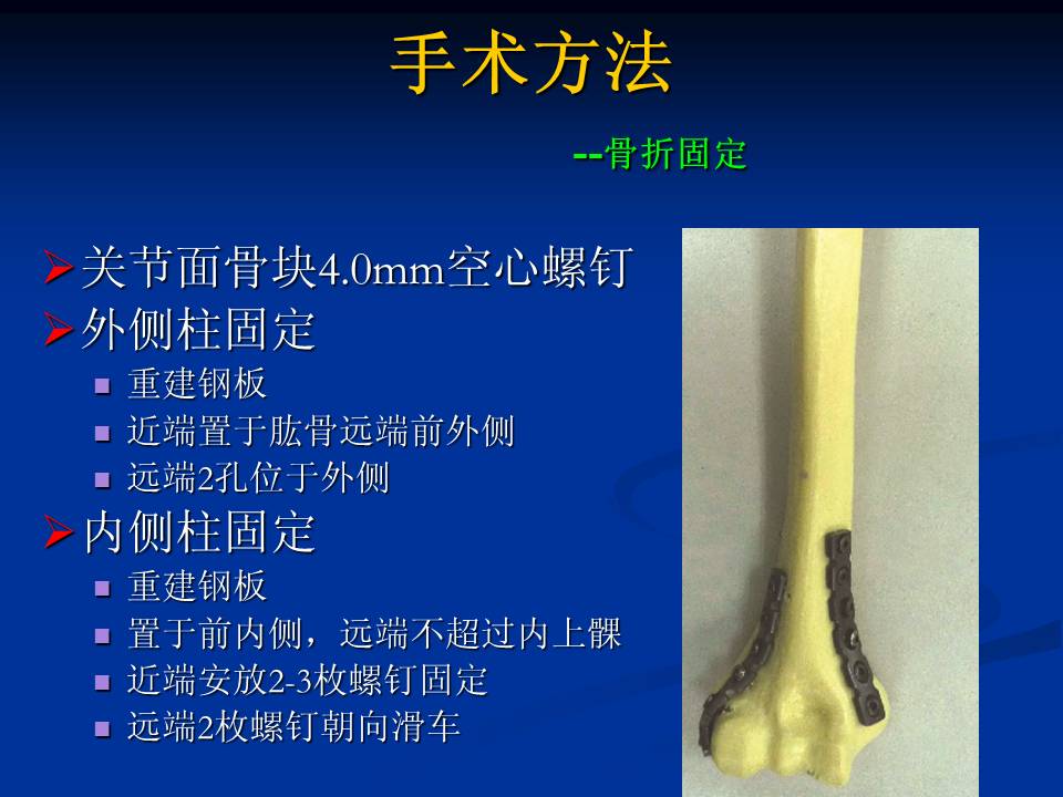 经肘关节内,外侧联合入路复位,前侧双柱固定治疗肱骨远端关节内骨折
