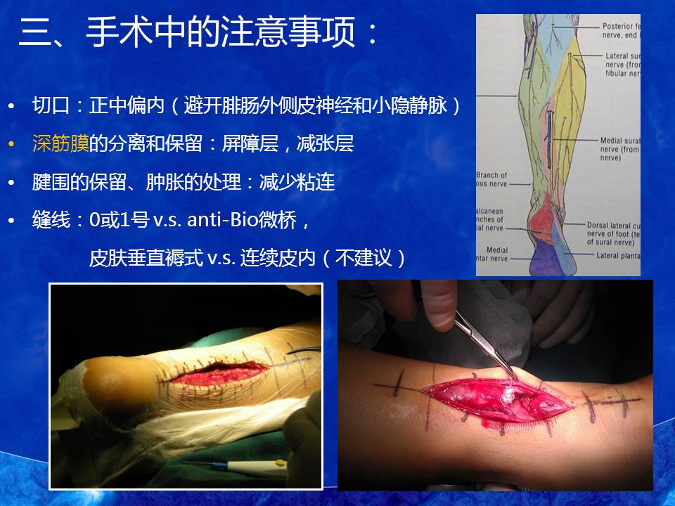 运动性跟腱断裂的诊断和处理