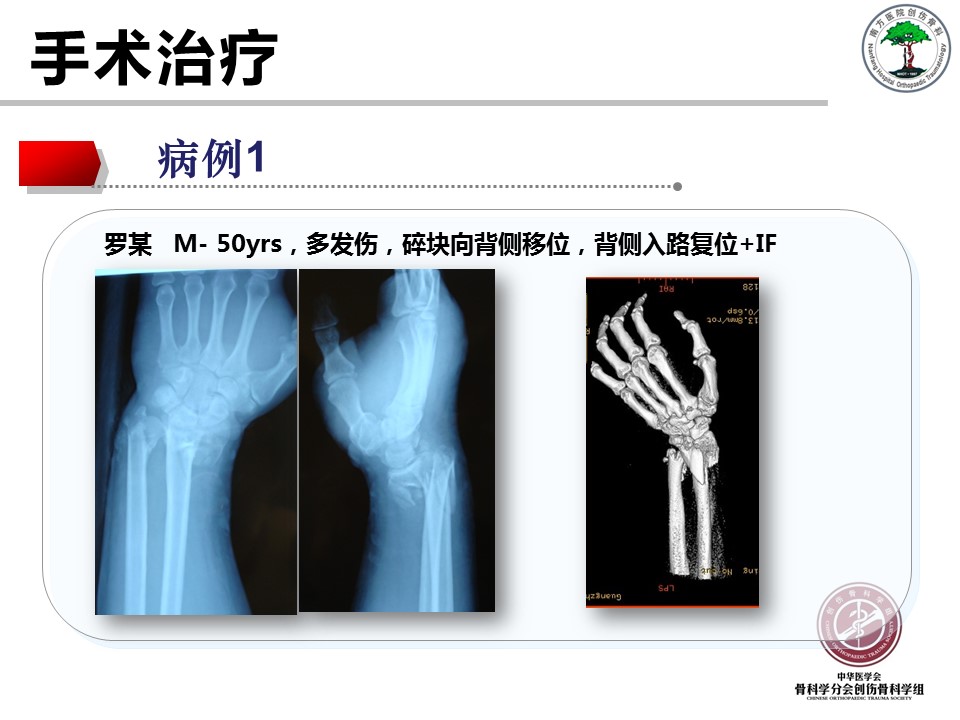 桡骨远端骨折的解剖及手术入路