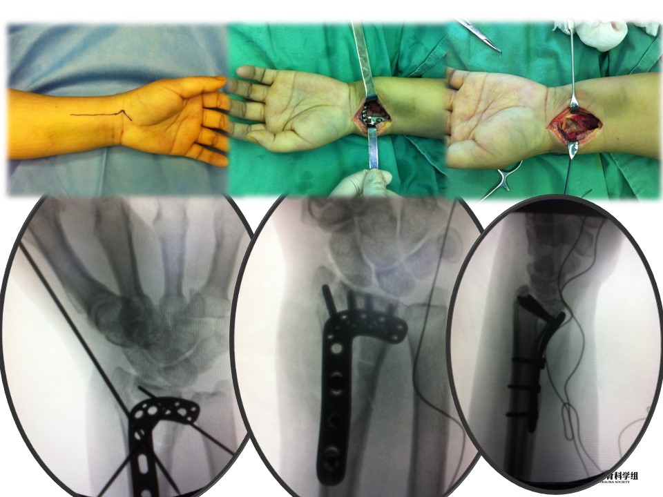 桡骨远端骨折的解剖及手术入路