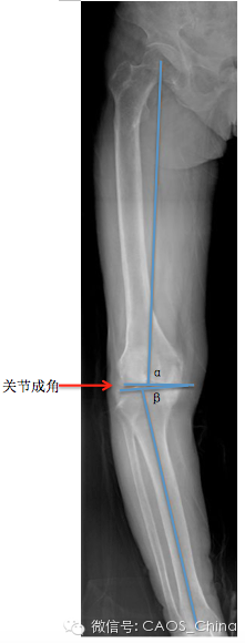 人工全膝关节置换与下肢力线重建:基础篇-骨医小灶第六期i & 