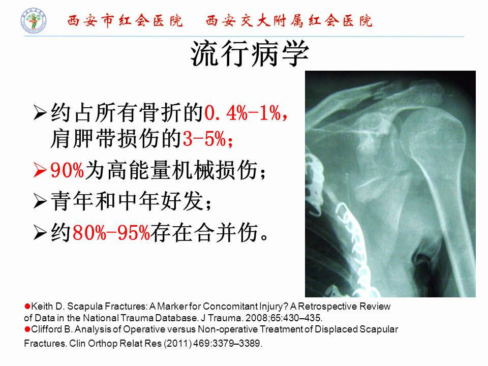 肩胛骨骨折的手术入路及固定方法