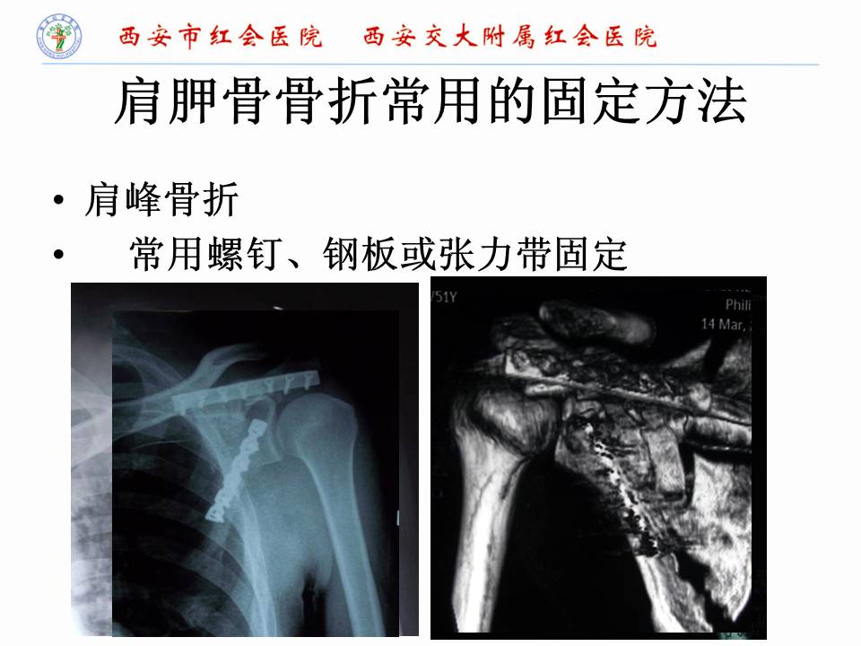 肩胛骨骨折的手术入路及固定方法