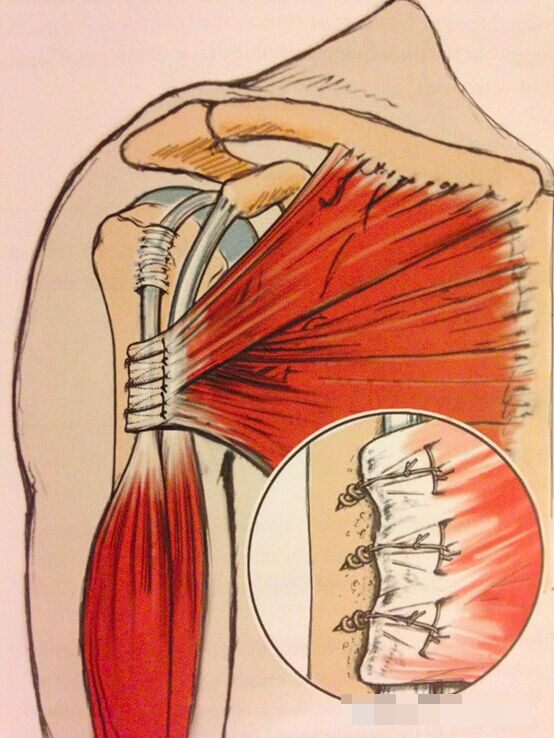 5-c 用锚钉上的缝线缝合断裂的胸大肌腱,重建胸大肌腱的止点(如图)