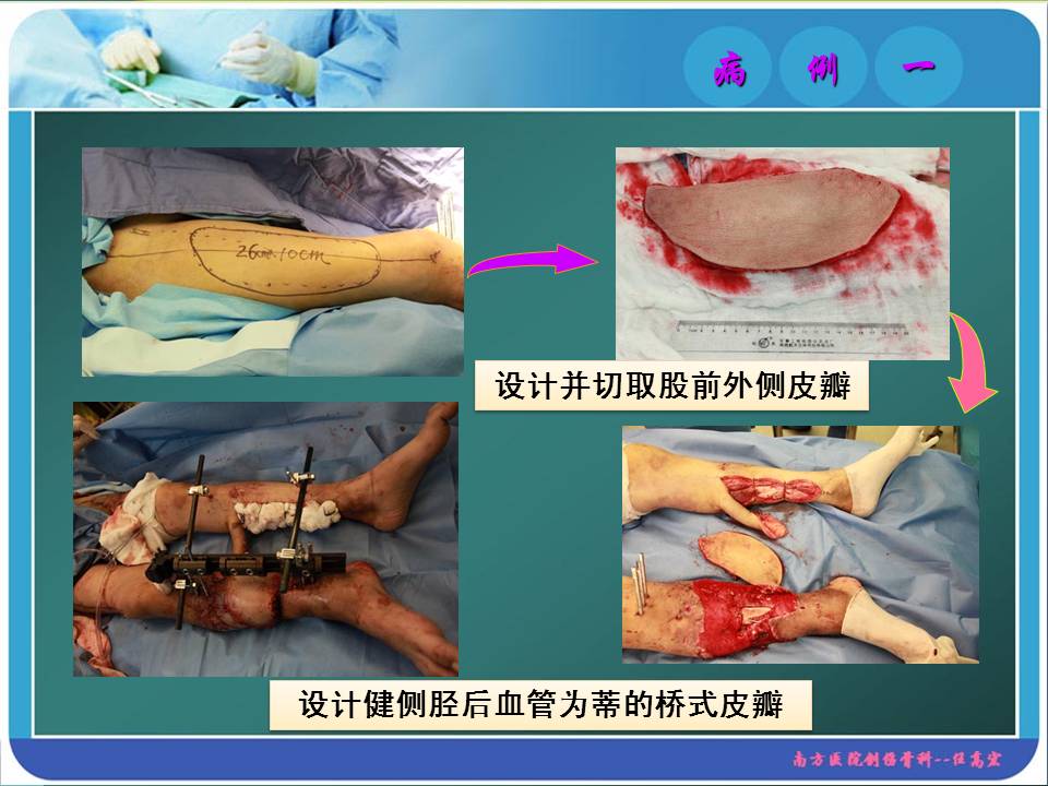 游离皮瓣移植失败后的大面积软组织缺损修复探讨