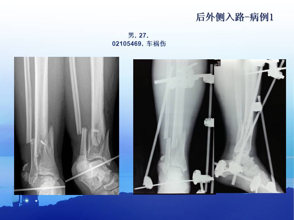 后外侧入路在pilon骨折中的应用