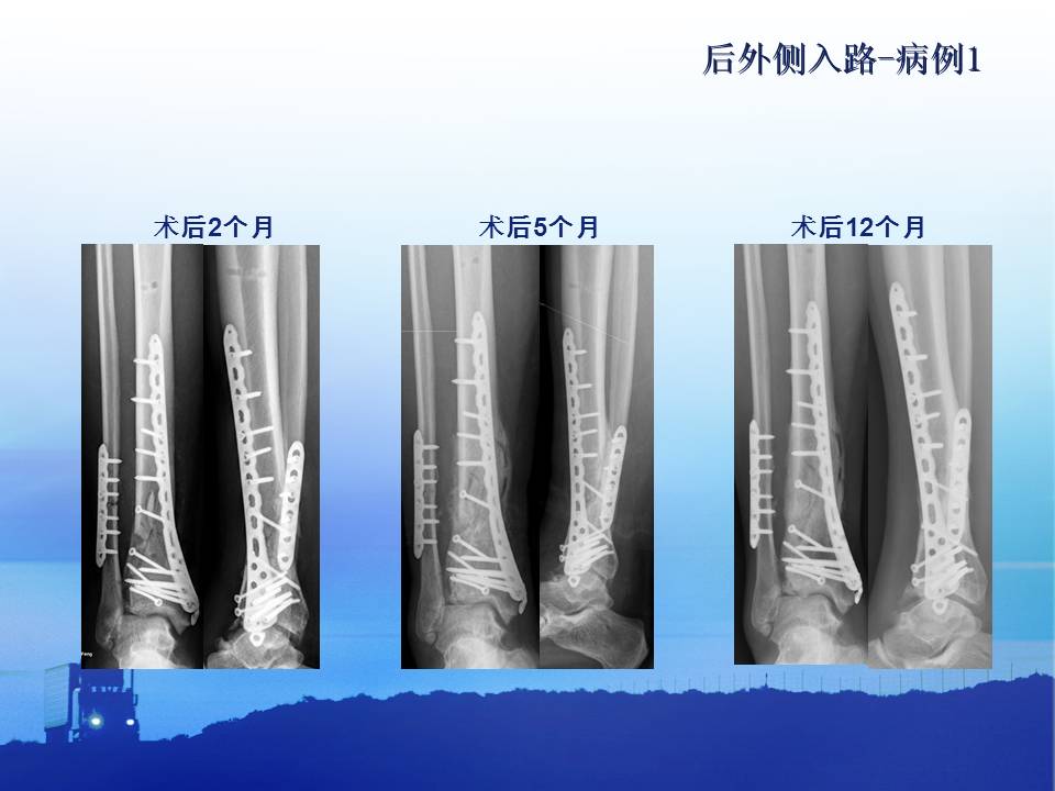 后外侧入路在pilon骨折中的应用