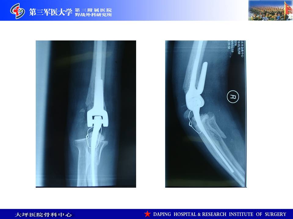 人工全肘关节置换与翻修手术经验