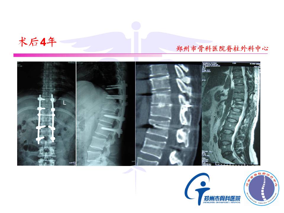 陈旧性胸腰椎骨折并后凸畸形分型及手术治疗策略