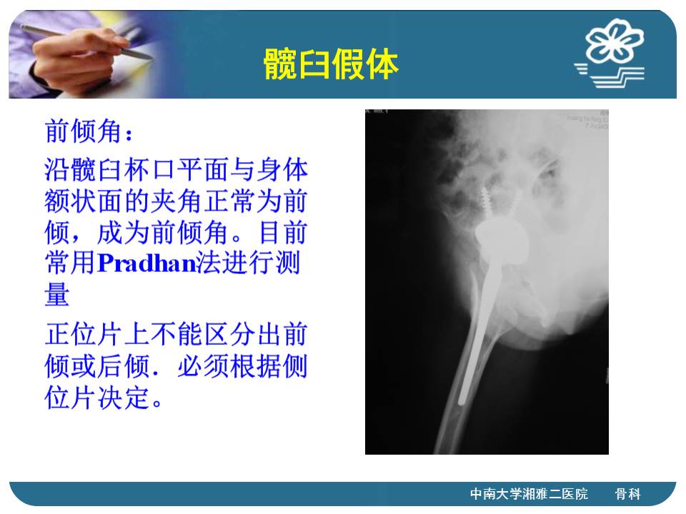 全髋关节置换术的x片评估