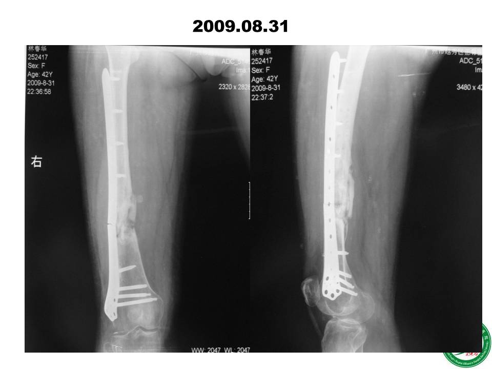 股骨大段骨缺损的修复