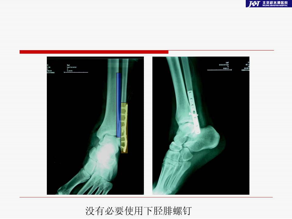 踝部骨折后何时需要固定下胫腓联合及相关问题