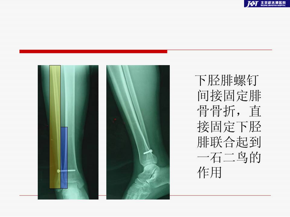 踝部骨折后何时需要固定下胫腓联合及相关问题