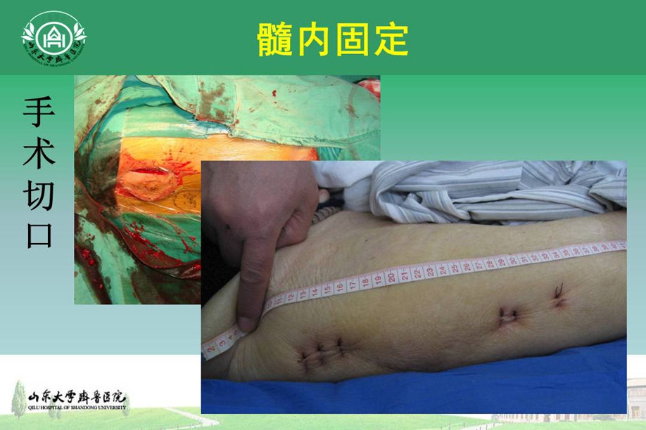 高龄股骨粗隆间骨折的治疗