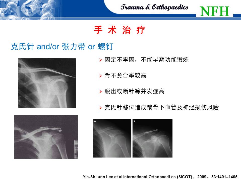 解剖型锁定钢板治疗锁骨远端骨折的临床研究