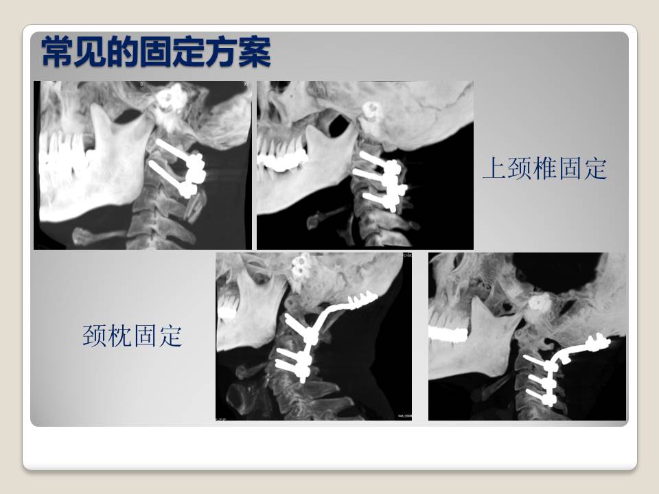 上颈椎失稳后路内固定范围的选择