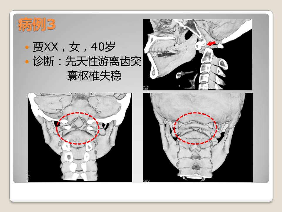 上颈椎失稳后路内固定范围的选择