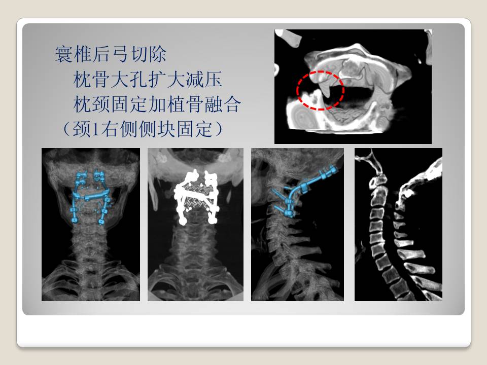 上颈椎失稳后路内固定范围的选择