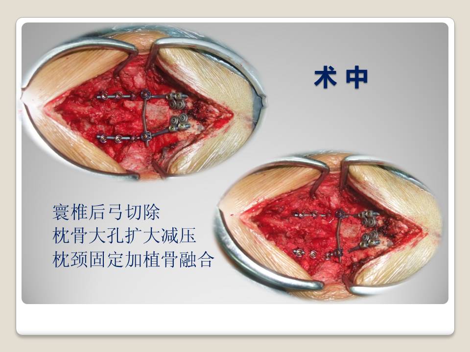 上颈椎失稳后路内固定范围的选择