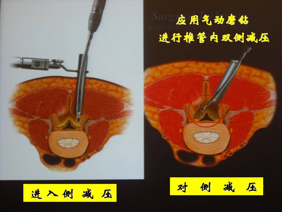 内镜下单侧入路双侧减压椎管扩大术治疗腰椎管狭窄症的术后临床疗效