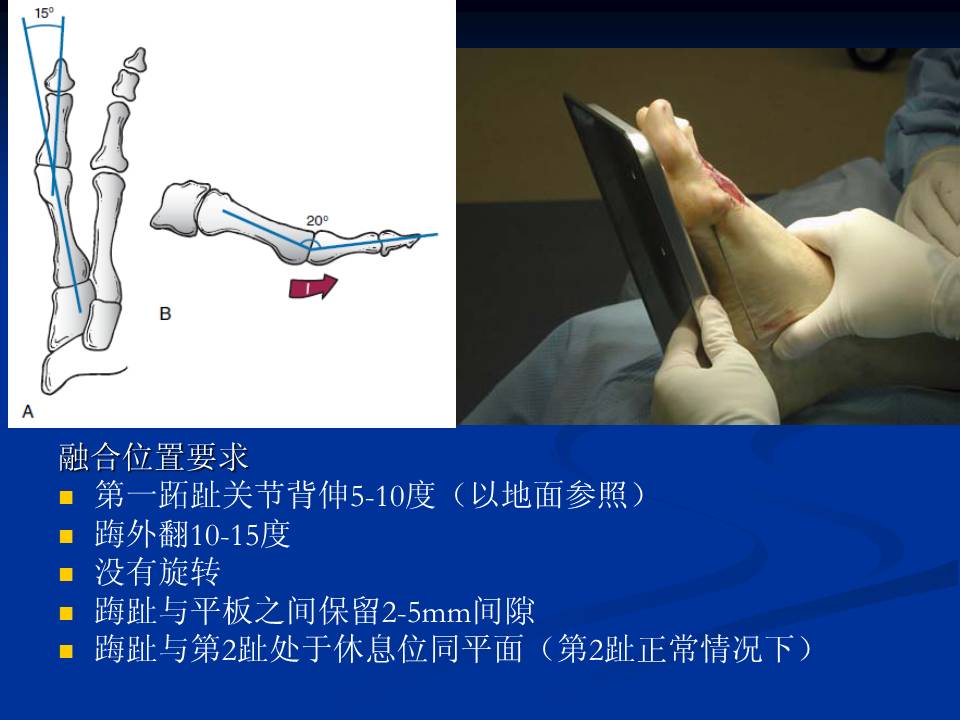 第一跖趾关节半关节置换