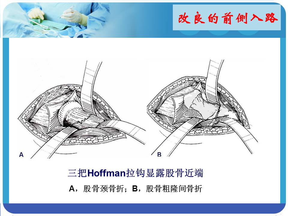 髋前入路在股骨近端骨折翻修术的应用