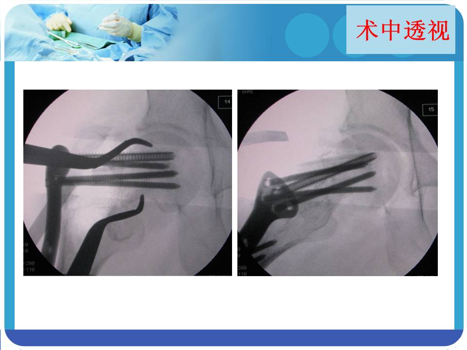 髋前入路在股骨近端骨折翻修术的应用