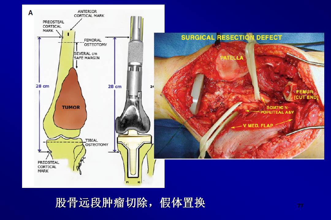 四肢恶性骨肿瘤的切除原则与术后康复