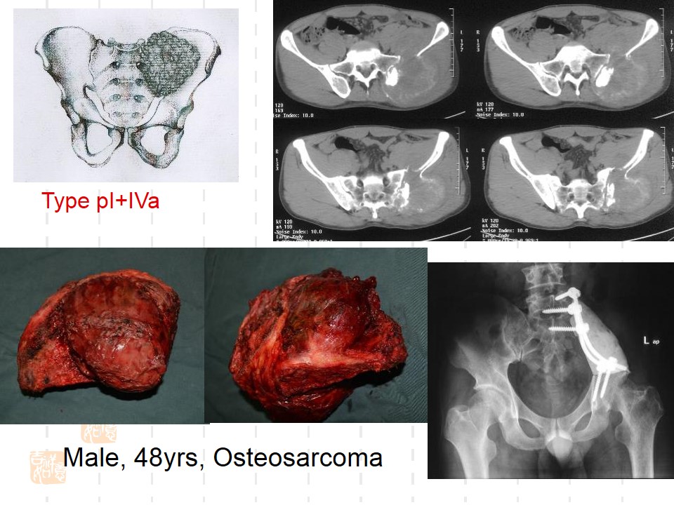 骨盆肿瘤累及骶骨的分型及外科治疗