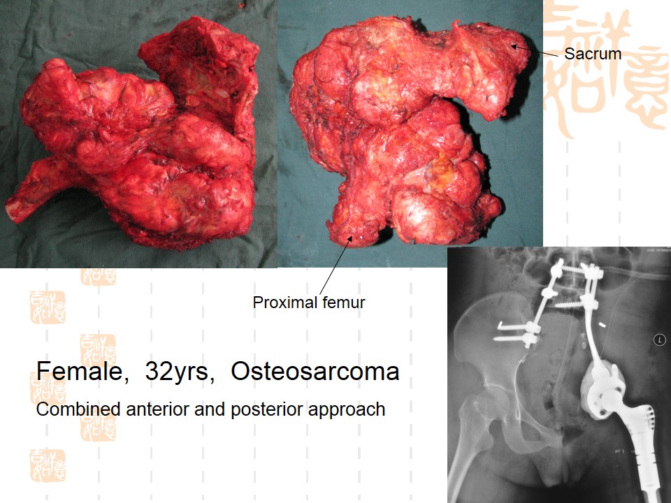 骨盆肿瘤累及骶骨的分型及外科治疗