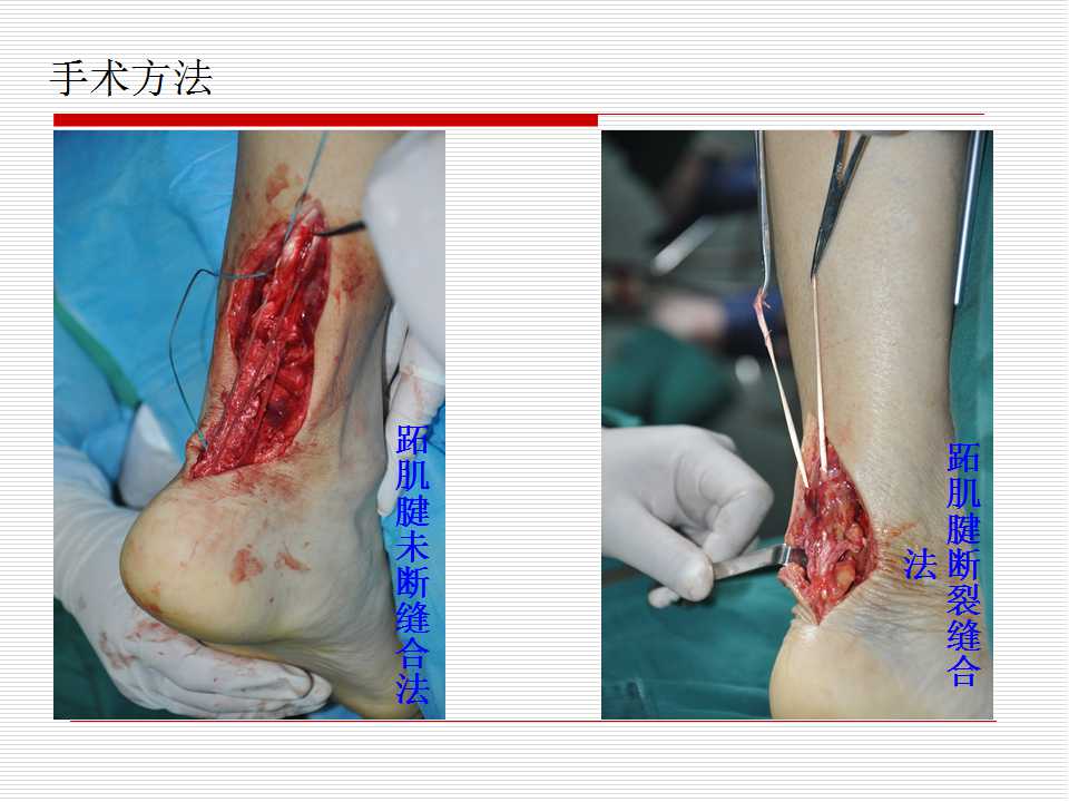跖肌腱在跟腱损伤修复中的应用