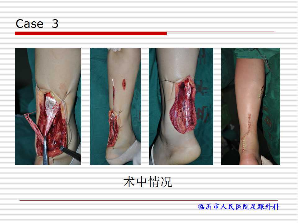 跖肌腱在跟腱损伤修复中的应用