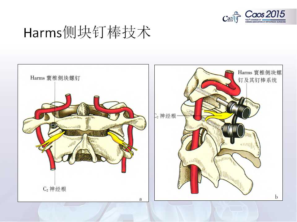 寰椎侧块螺钉固定技术