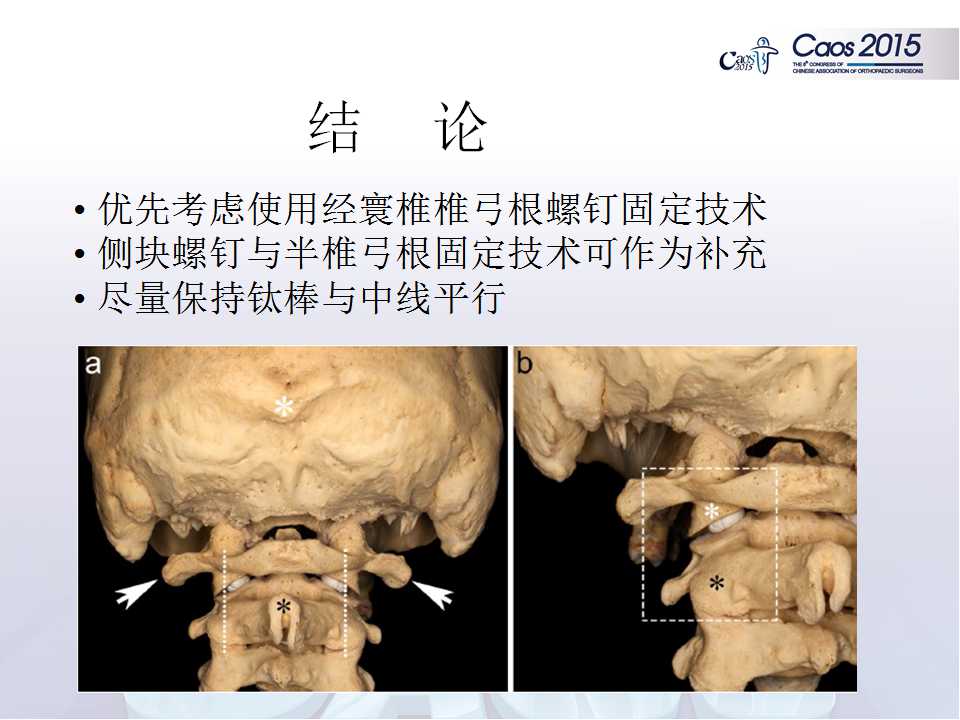 寰椎侧块螺钉固定技术