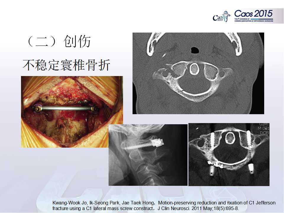 寰椎侧块螺钉固定技术