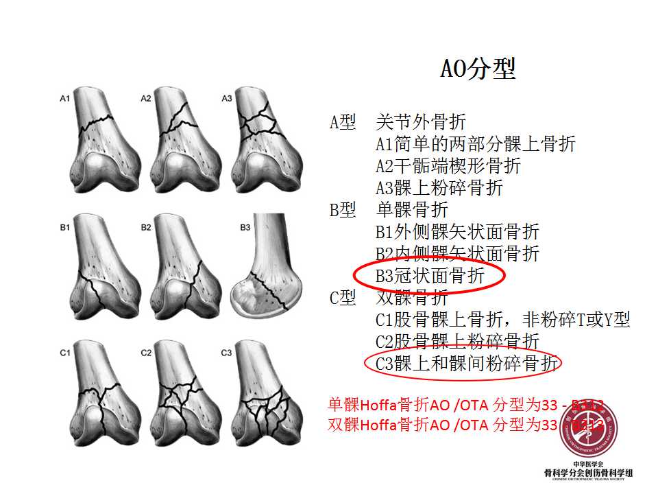 股骨远端hoffa骨折手术入路及固定