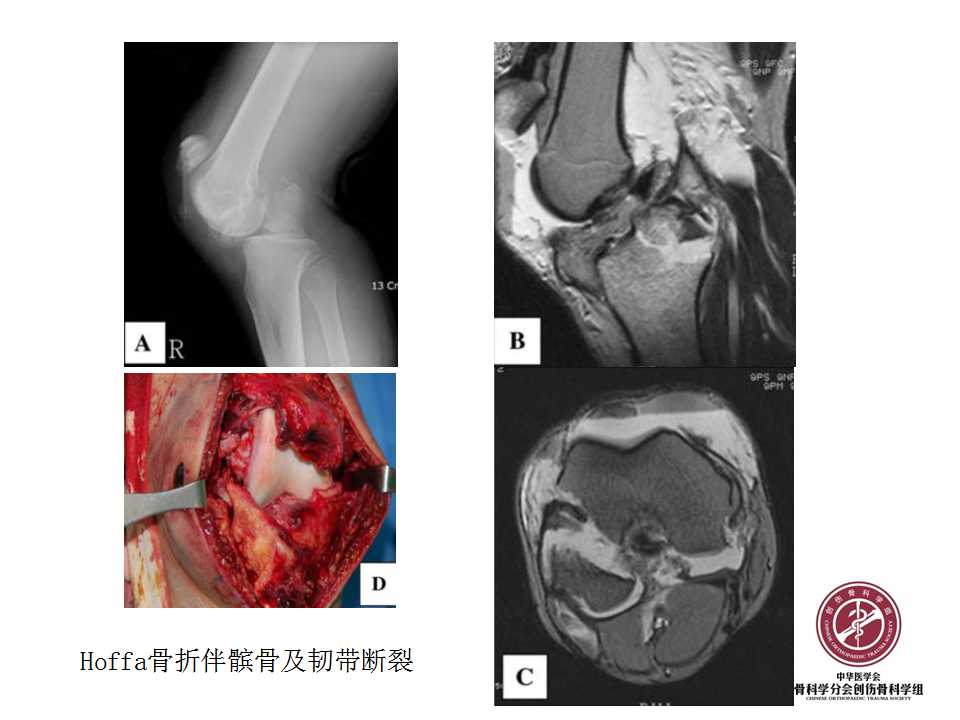 股骨远端hoffa骨折手术入路及固定