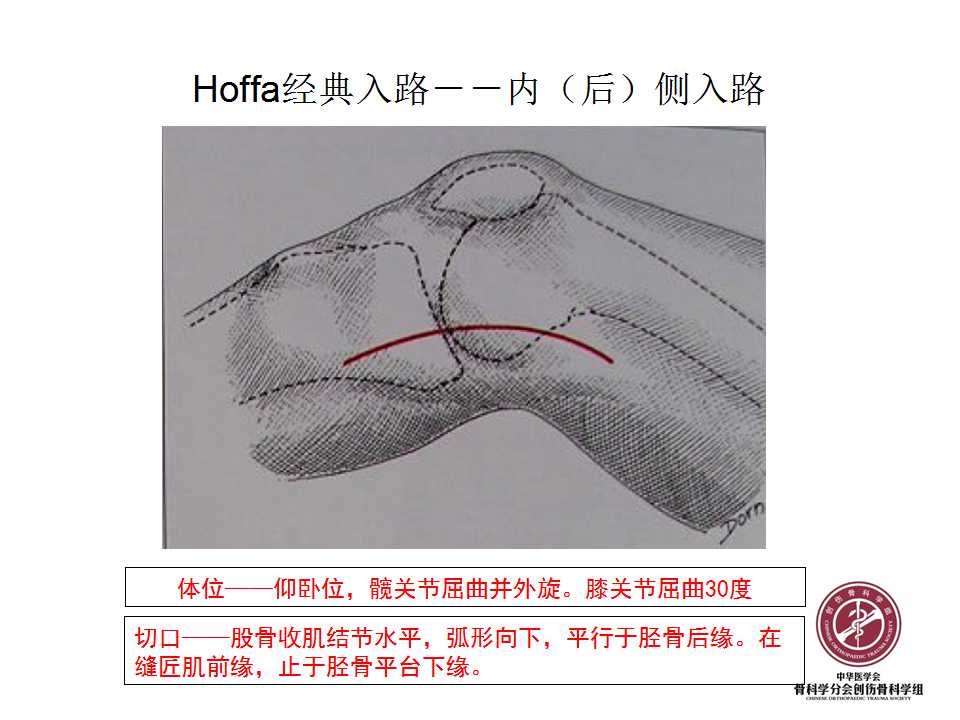 股骨远端hoffa骨折手术入路及固定