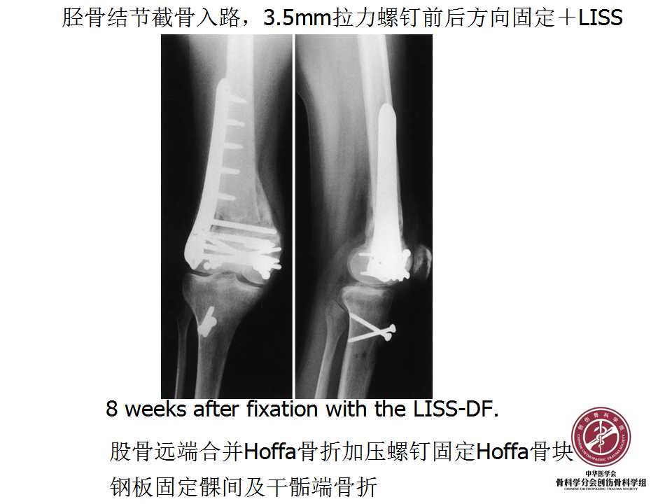 股骨远端hoffa骨折手术入路及固定