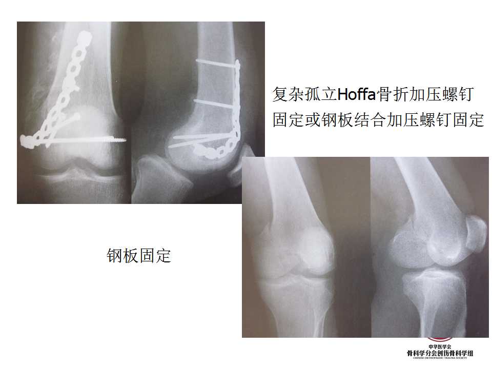 股骨远端hoffa骨折手术入路及固定