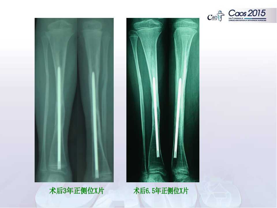 联合手术治疗儿童先天性胫骨假关节