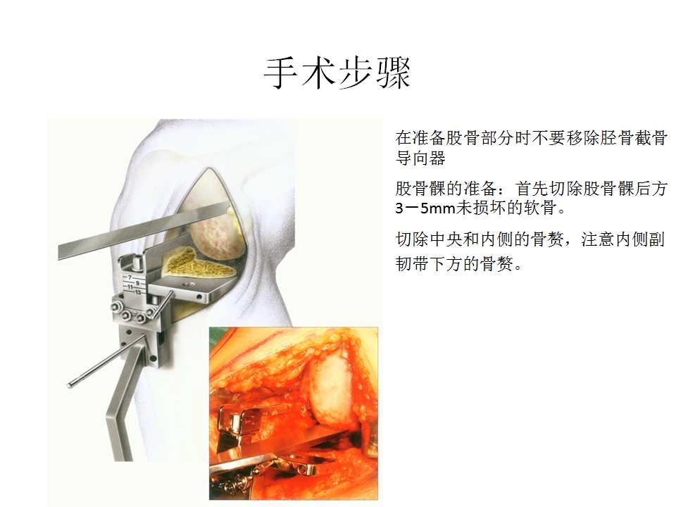 单髁关节置换复兴了吗?