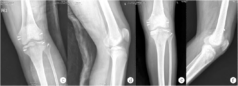 膝关节多韧带损伤的手术治疗