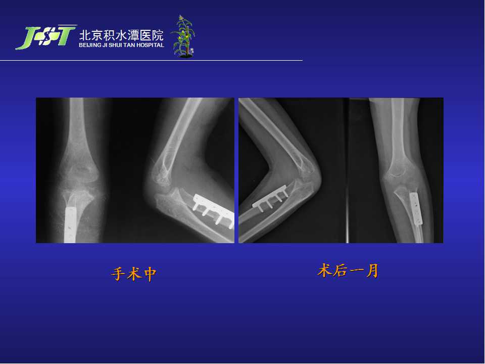 儿童孟氏骨折骨科医生的梦魇