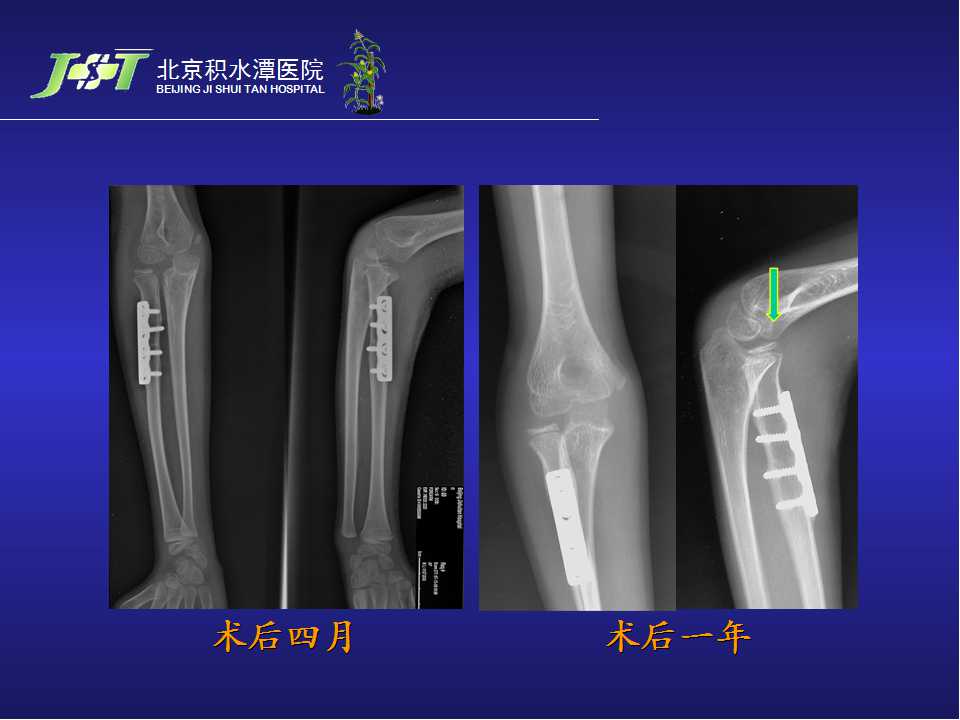 儿童孟氏骨折骨科医生的梦魇