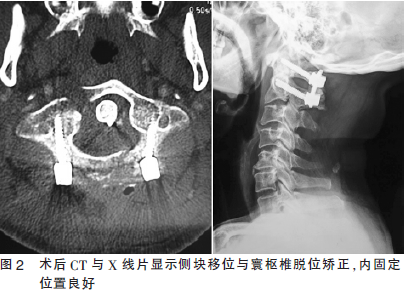 寰枢椎椎弓根钉内固定植骨融合术治疗不稳定寰椎爆裂骨折