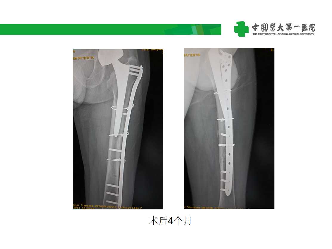 右髋臼假体破裂松动伴髋臼骨缺损图片_自贡市第一人民医院