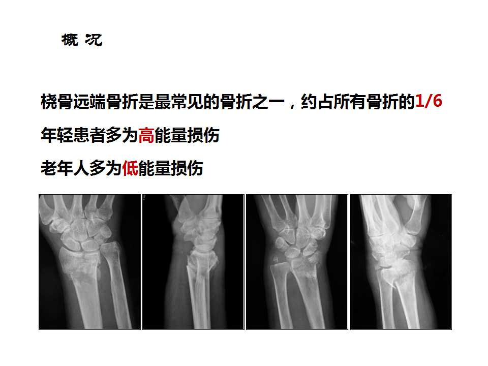 桡骨远端骨折治疗中应注意的问题