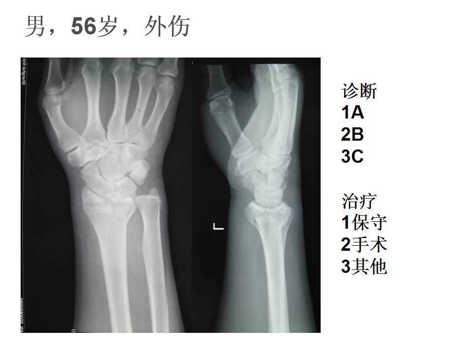 桡骨远端骨折治疗中应注意的问题