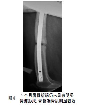 股骨干骨折髓内钉固定后非感染性骨不连的原因分析及治疗